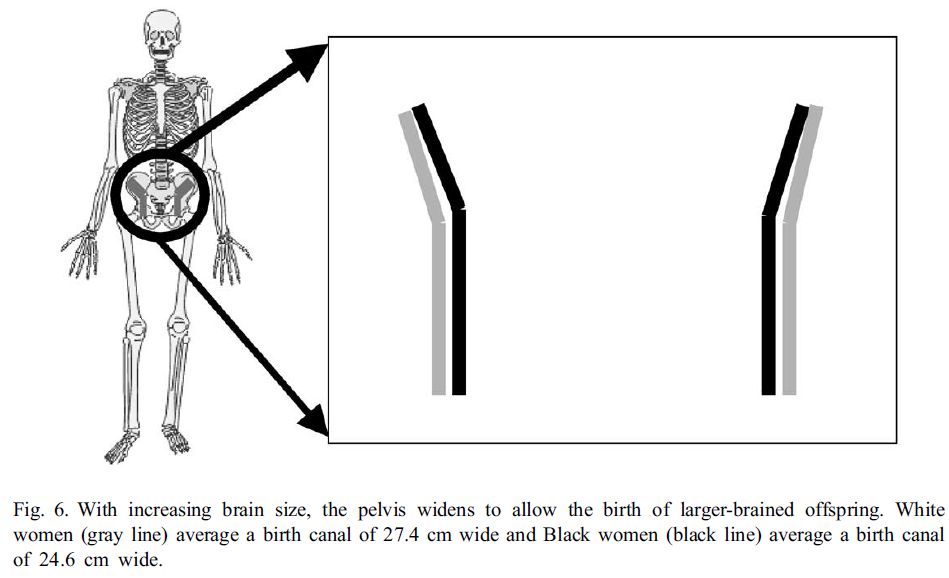 Différences raciales dans la taille du pelvis